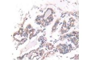 IHC-P analysis of Human Breast Cancer Tissue, with DAB staining. (IFNA5 anticorps  (AA 22-189))