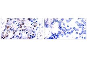 Immunohistochemical analysis of paraffin-embedded human breast carcinoma tissue using c-Jun (Ab-91) antibody (E021021). (C-JUN anticorps)