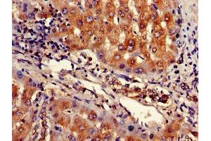 Immunohistochemistry of paraffin-embedded human liver cancer using ABIN7167943 at dilution of 1:100 (ARHGAP25 anticorps  (AA 17-280))