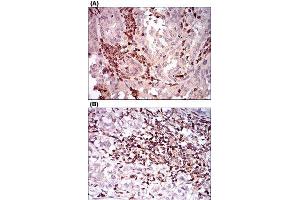 Immunohistochemical staining of human endometrial cancer tissues (A) and bladder cancer tissues (B) with CTNNBL1 monoclonal antibody, clone 1E4F5  at 1:200-1:1000 dilution. (CD68 anticorps  (AA 42-155))