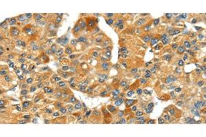 Immunohistochemistry of paraffin-embedded Human liver cancer using SPARC Polyclonal Antibody at dilution of 1:35 (SPARC anticorps)