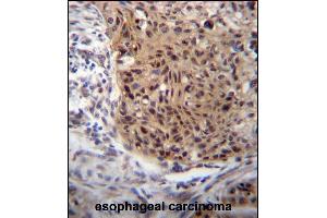 EXTL3 Antibody (N-term) (ABIN656662 and ABIN2845903) immunohistochemistry analysis in formalin fixed and paraffin embedded human esophageal carcinoma followed by peroxidase conjugation of the secondary antibody and DAB staining.
