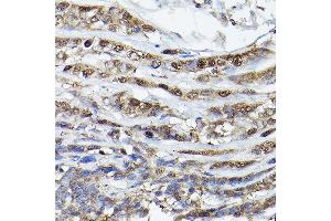 Immunohistochemistry of paraffin-embedded human esophageal cancer using PHD3 Rabbit pAb (ABIN6130355, ABIN6139990, ABIN6139991 and ABIN6224021) at dilution of 1:150 (40x lens).