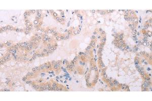 Immunohistochemistry of paraffin-embedded Human thyroid cancer tissue using TPO Polyclonal Antibody at dilution 1:50 (TPO anticorps)