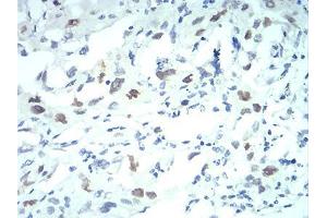 Immunohistochemical analysis of paraffin-embedded lung cancer tissues using KPNA2 mouse mAb with DAB staining.