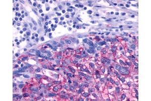 Anti-ADRB3 antibody IHC of human Ovary, Carcinoma.