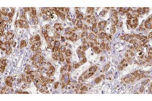 ABIN6278496 at 1/100 staining Human liver cancer tissue by IHC-P. (GRIN2C anticorps  (Internal Region))