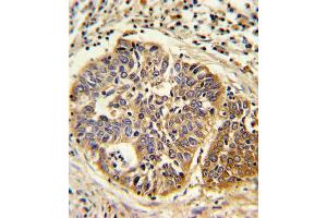 Formalin-fixed and paraffin-embedded human lung carcinoma reacted with HMGCS1 Antibody , which was peroxidase-conjugated to the secondary antibody, followed by DAB staining.