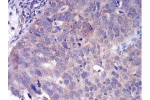 Immunohistochemical analysis of paraffin-embedded ovarian cancer tissues using FGFR3 mouse mAb with DAB staining.