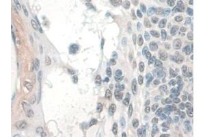 Detection of COQ6 in Human Skin cancer Tissue using Polyclonal Antibody to Coenzyme Q6 Homolog, Monooxygenase (COQ6)