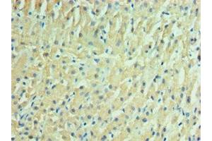 Immunohistochemistry of paraffin-embedded human liver cancer using ABIN7157125 at dilution of 1:100 (IDH2 anticorps  (AA 193-452))