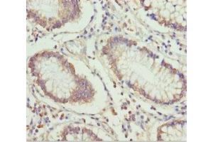 Immunohistochemistry of paraffin-embedded human colon cancer using ABIN7151499 at dilution of 1:100 (ETFA anticorps  (AA 1-333))