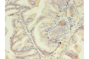 Immunohistochemistry of paraffin-embedded human prostate cancer using ABIN7176718 at dilution of 1:100 (AZGP1 anticorps  (AA 61-210))