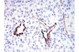 Immunohistochemical analysis of paraffin-embedded human liver cancer tissues using GKAP mouse mAb with DAB staining.