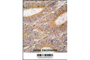 Formalin-fixed and paraffin-embedded human colon carcinoma tissue reacted with AIK antibody , which was peroxidase-conjugated to the secondary antibody, followed by DAB staining.