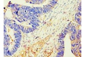 Immunohistochemistry of paraffin-embedded human ovarian cancer using ABIN7145213 at dilution of 1:100