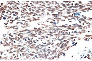 Immunohistochemistry of paraffin-embedded Human lung cancer using AQR Polyclonal Antibody at dilution of 1:100 (40x lens). (AQR anticorps)