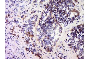 Formalin-fixed and paraffin embedded human colon carcinoma labeled with Anti-SPARC Polyclonal Antibody, Unconjugated  at 1:200 followed by conjugation to the secondary antibody and DAB staining.