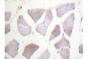 Immunohistochemistry analyzes of PP1α (G315) antibody in paraffin-embedded human breast carcinoma tissue. (CRYAB anticorps)
