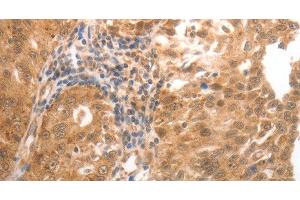 Immunohistochemistry of paraffin-embedded Human ovarian cancer tissue using MMP27 Polyclonal Antibody at dilution 1:50 (MMP27 anticorps)
