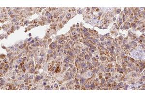 ABIN6273127 at 1/100 staining Human Melanoma tissue by IHC-P. (INHBA anticorps  (Internal Region))
