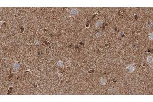 ABIN6277746 at 1/100 staining Human brain cancer tissue by IHC-P.