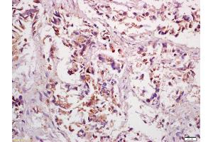 Formalin-fixed and paraffin embedded human gastric cancer labeled with Anti-PPP4C Polyclonal Antibody, Unconjugated (ABIN669261) at 1:200 followed by conjugation to the secondary antibody and DAB staining
