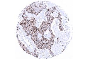 Merkel cell carcinoma with moderate to strong TdT immunostaining in _80 of tumor cells.