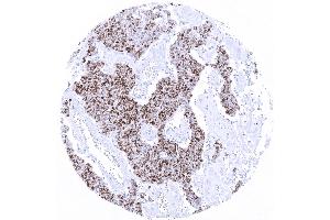 Merkel cell carcinoma with moderate to strong TdT immunostaining in _80 of tumor cells. (Recombinant TdT anticorps)
