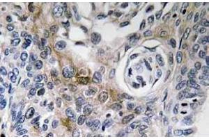 Immunohistochemistry analysis of CD63 antibody in Paraffin-Embedded Human lung carcinoma tissue. (CD63 anticorps)