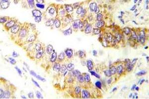 Immunohistochemistry (IHC) analyzes of Tsc2 antibody in paraffin-embedded human lung carcinoma tissue. (Tuberin anticorps)