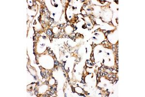 Anti-ALDH2 antibody, IHC(P) IHC(P): Human Liver Cancer Tissue