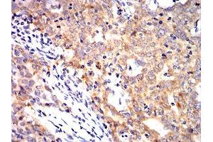 Immunohistochemical analysis of paraffin-embedded breast cancer tissues using KRT10 mouse mAb with DAB staining.