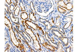 ABIN6258577 and ABIN6274797 at 1/100 staining Human kidney cancer and adjacent normal tissues by IHC-P.
