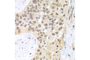 Immunohistochemistry of paraffin-embedded human lung cancer using PSMC5 antibody at dilution of 1:100 (400x lens). (PSMC5 anticorps)