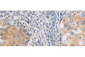 Immunohistochemistry of paraffin-embedded Human breast cancer tissue using GBA Polyclonal Antibody at dilution of 1:55(x200) (GBA anticorps)