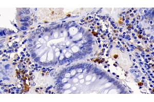Detection of CASP3 in Human Colorectal cancer Tissue using Monoclonal Antibody to Caspase 3 (CASP3)