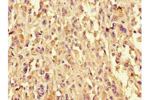 Immunohistochemistry of paraffin-embedded human melanoma using ABIN7149074 at dilution of 1:100