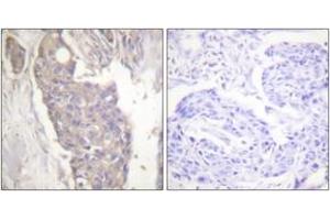 Immunohistochemistry analysis of paraffin-embedded human breast carcinoma tissue, using FAS Antibody. (FAS anticorps  (AA 281-330))