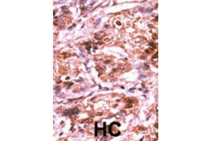 Immunohistochemistry (IHC) image for anti-Cell Division Cycle 25 Homolog A (S. Pombe) (CDC25A) (pSer293) antibody (ABIN2970938)