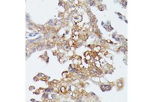 Immunohistochemistry of paraffin-embedded human lung cancer using MK4 antibody (ABIN7268654) at dilution of 1:100 (40x lens). (MAP3K4 anticorps  (AA 1-100))