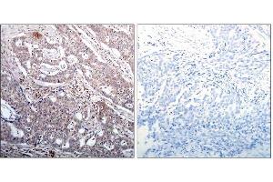 Immunohistochemical analysis of paraffin-embedded human breast carcinoma tissue, using IκB-β (Phospho-Ser23) antibody (E011304). (NFKBIB anticorps  (pSer23))