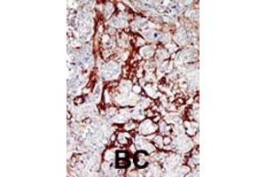 Formalin-fixed and paraffin-embedded human cancer tissue reacted with the primary antibody, which was peroxidase-conjugated to the secondary antibody, followed by DAB staining.
