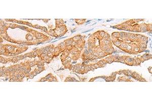 Immunohistochemistry of paraffin-embedded Human thyroid cancer tissue using CYB5D1 Polyclonal Antibody at dilution of 1:45(x200) (CYB5D1 anticorps)