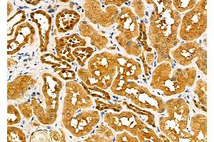 ABIN6260517 and ABIN6277589 at 1/100 staining Human kidney cancer and adjacent normal tissues by IHC-P.