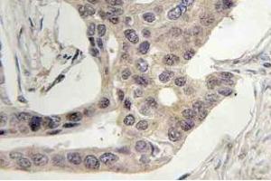 Immunohistochemistry (IHC) analyzes of SLP-76 antibody in paraffin-embedded human breast carcinoma tissue.