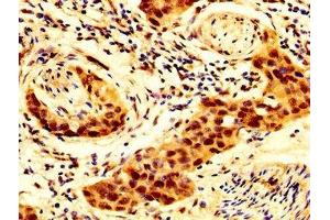 IHC image of ABIN7143973 diluted at 1:300 and staining in paraffin-embedded human bladder cancer performed on a Leica BondTM system.