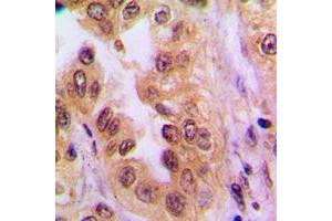 Immunohistochemical analysis of NF-kappaB p65 (AcK310) staining in human lung cancer formalin fixed paraffin embedded tissue section.