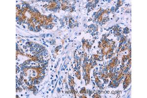 Immunohistochemistry of Human colon cancer using AGFG1 Polyclonal Antibody at dilution of 1:50 (AGFG1 anticorps)