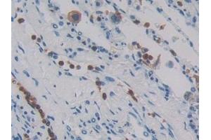 Detection of MASP1 in Human Lung cancer Tissue using Polyclonal Antibody to Mannose Associated Serine Protease 1 (MASP1)